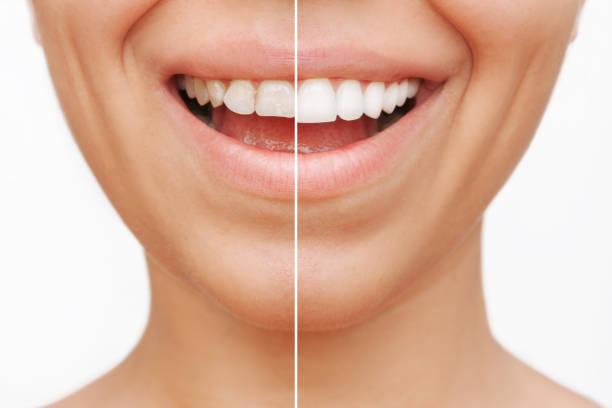 Gülüş Tasarımı Nedir? Estetik Gülüşe Nasıl Sahip Olunur? - görsel-19
