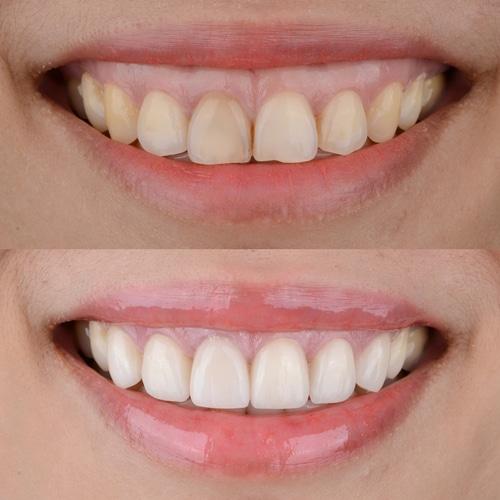 Gülüş Tasarımı Nedir? Estetik Gülüşe Nasıl Sahip Olunur? - görsel-32