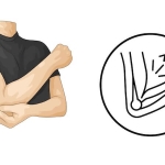 Dirsekte Sinir Sıkışması (Kubital Tünel Sendromu): Ameliyat Gerektiren Durumlar ve İyileşme Süreci