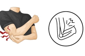 Dirsekte Sinir Sıkışması (Kubital Tünel Sendromu): Ameliyat Gerektiren Durumlar ve İyileşme Süreci