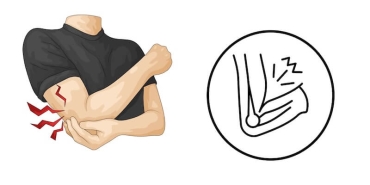 Dirsekte Sinir Sıkışması (Kubital Tünel Sendromu): Ameliyat Gerektiren Durumlar ve İyileşme Süreci