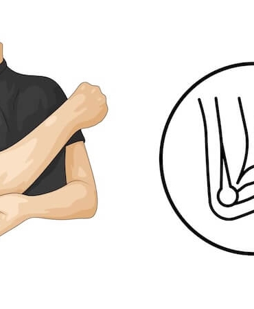 Dirsekte Sinir Sıkışması (Kubital Tünel Sendromu): Ameliyat Gerektiren Durumlar ve İyileşme Süreci