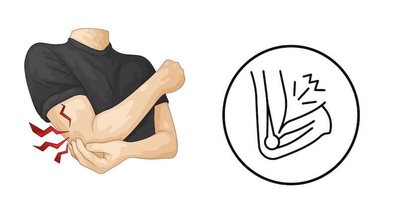 Dirsekte Sinir Sıkışması (Kubital Tünel Sendromu): Ameliyat Gerektiren Durumlar ve İyileşme Süreci